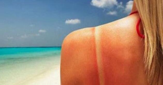 Dikkat! Cildinizi kaşımayın ve soymayın! Güneş yanığına karşı 12 etkili öneri